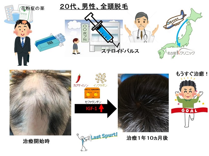 円形脱毛症　病院